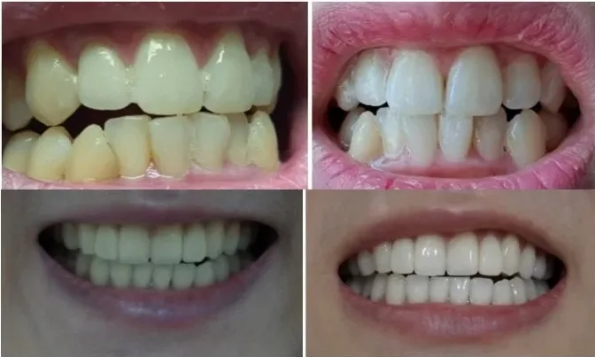 Gustus Plus Teeth Whitening Gel 4g - Image 2