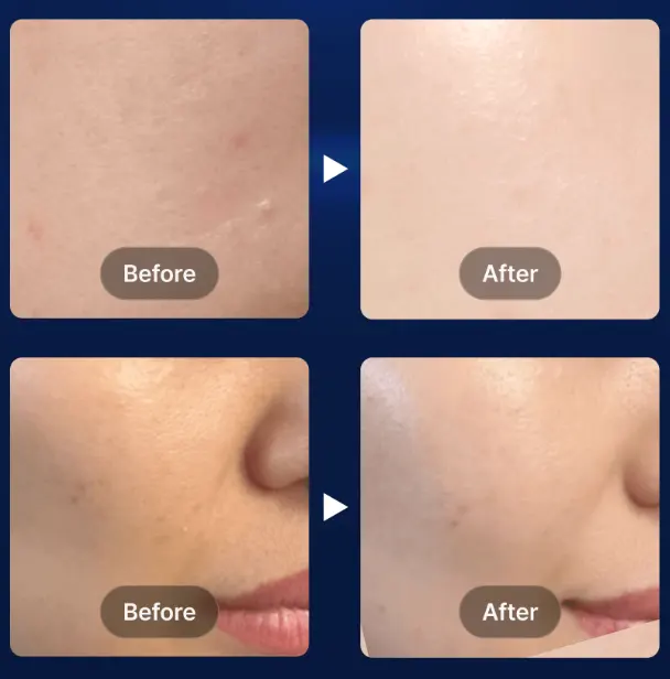 ASCEplus Rose-Exosome Skin Boosting Ampoule Pro 3.5ml x 5 Vials - High Concentration, 7-Day Skin Resuscitation
