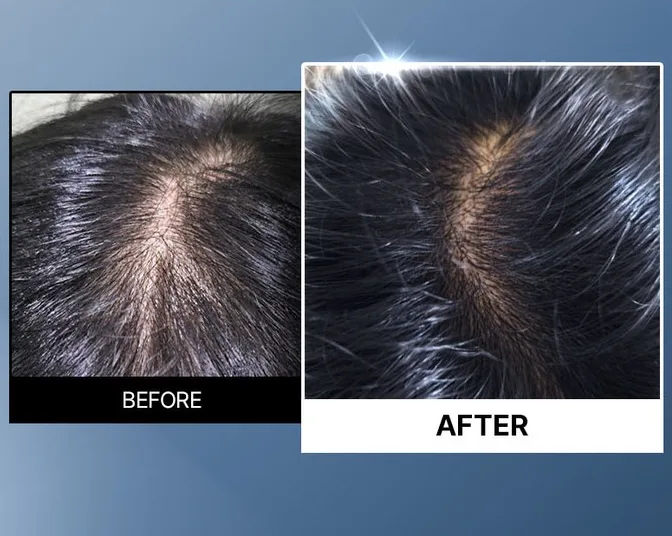 AEPE Scalp Boosting Scalp Hair Loss Ampoule 150ml - Image 3