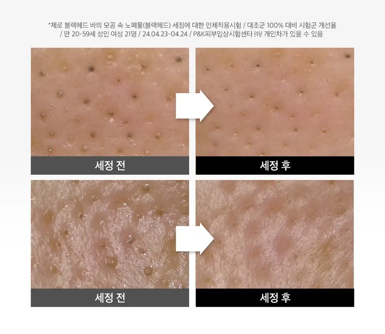 23yearsold ZERO BLACKHEAD BAR 50g 2pcs Detail