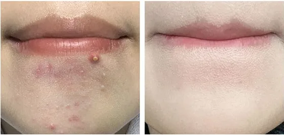 Elimere Cabbage BHA Acne-Functional Low-pH Foam Cleansing 120ml - Image 3