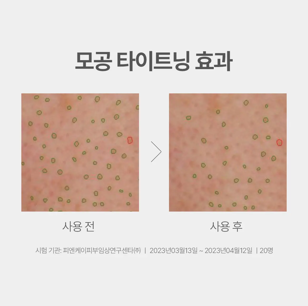 에이솔루션 아크네 클리어 어성초 토너 200ml Detail